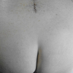 Pic #2 Surgery